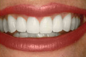 Whitening_A